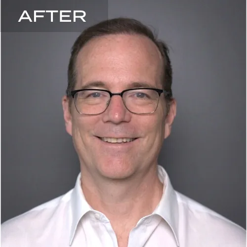 Hair Transplant Before After Result 1