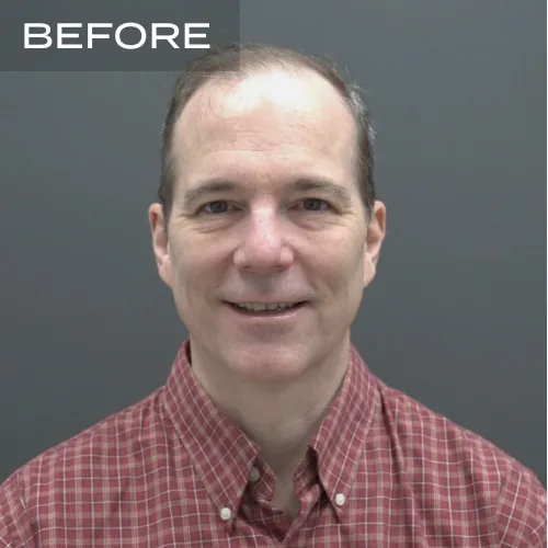 Hair Transplant Before After Result 3