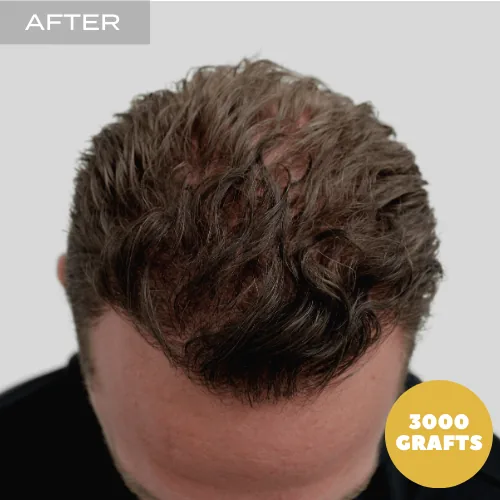 FUE Procedure Walkthrough