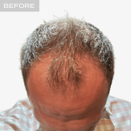 FUT Hair Transplant 3200 Grafts