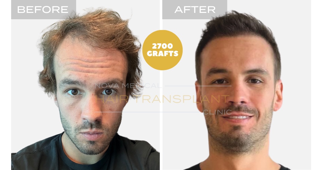 Hair Transplant Before & After Result 1 - HAIRLINE + DENSITY RESTORATION. MANUAL FUE 2700 GRAFTS., Nova Medical Kentucky