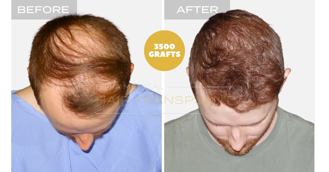 Hair Transplant Before & After Result 2 - HAIRLINE FORMATION + CROWN DENSITY RESTORATION. MICRO FUE 3500 GRAFTS., Nova Medical Kentucky