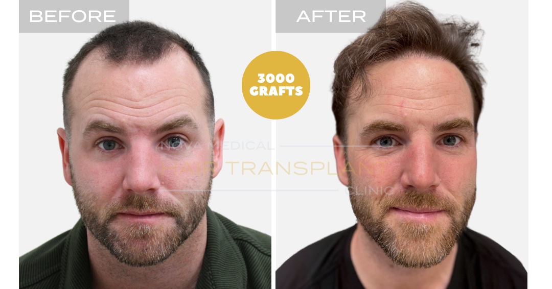 Hair Transplant Before & After Result 4 - HAIRLINE RESTORATION + DENSITY FILLING. MANUAL FUE 3000 GRAFTS., Nova Medical Kentucky