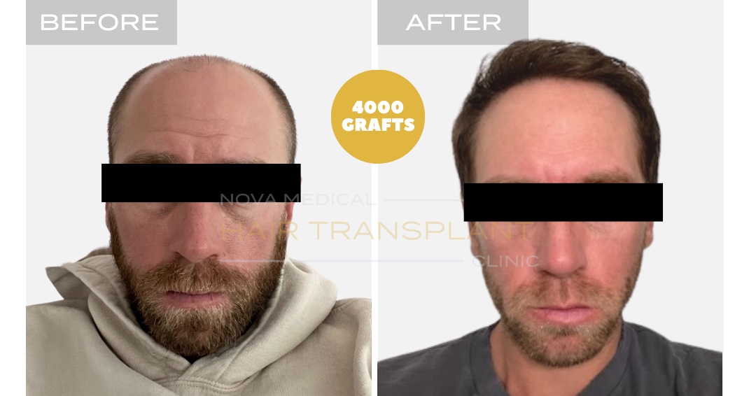 Hair Transplant Before & After Result 5 - HAIRLINE FORMATION + CROWN DENSITY RESTORATION. MANUAL FUE 4000 GRAFTS + DHI., Nova Medical Kentucky