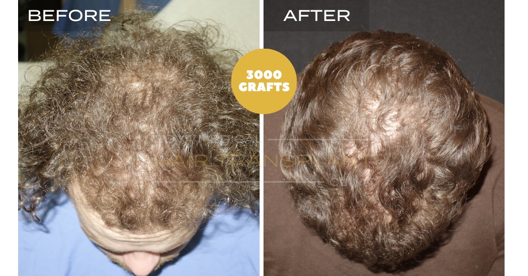 Hair Transplant Before & After Result 6 - FOR CURLY HAIR. DENSITY FILLING. SHAVELESS MANUAL FUE 3000 GRAFTS, Nova Medical Kentucky