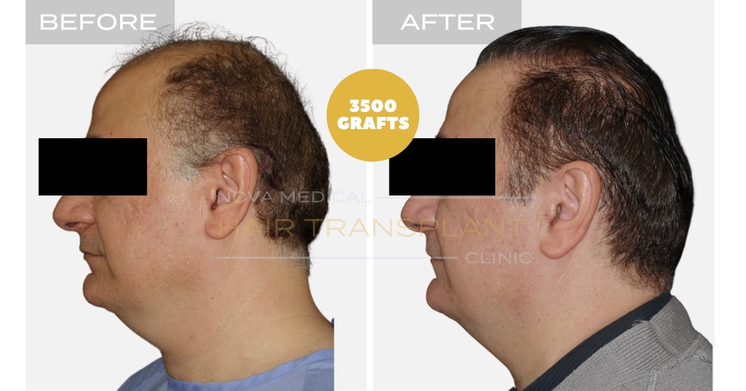 Hair Transplant Before & After Result 8 - HAIRLINE FORMATION + CROWN DENSITY RESTORATION. MANUAL FUE 3500 GRAFTS., Nova Medical Kentucky