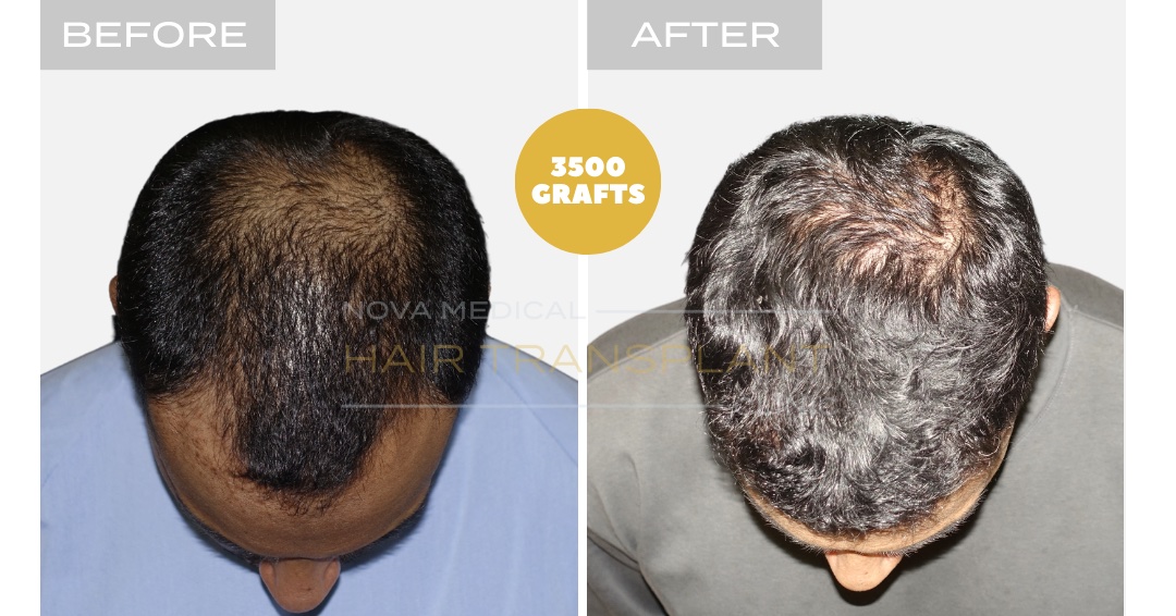 Hair Transplant Before & After Result 10 - THICK HAIR HAIRLINE RESTORATION. MANUAL FUE 3500 GRAFTS., Nova Medical Kentucky