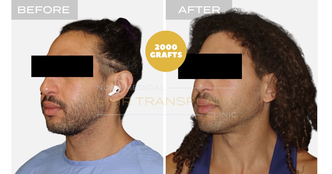 Hair Transplant Before & After Result 12 - NON-SHAVE CURLY HAIRLINE RESTORATION. MANUAL FUE 2000 GRAFTS., Nova Medical Kentucky