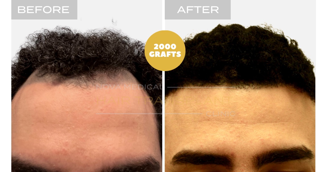Hair Transplant Before & After Result 13 - HAIRLINE RESTORATION + DENSITY FILLING. MANUAL FUE 3000 GRAFTS., Nova Medical Kentucky