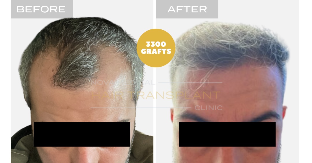 Hair Transplant Before & After Result 14 - HAIRLINE + FRONTAL DENSITY RESTORATION. MANUAL FUE 3000 GRAFTS., Nova Medical Kentucky