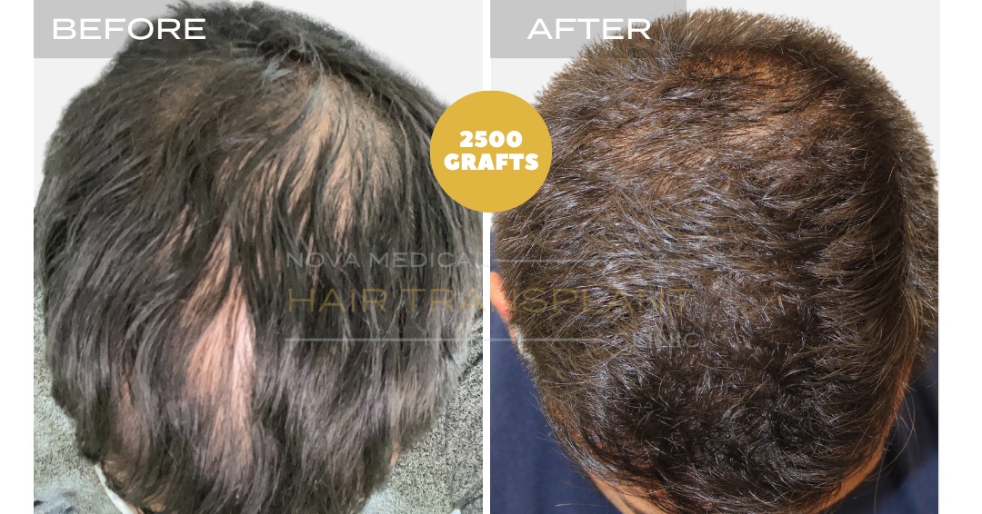 Hair Transplant Before & After Result 15 - HAIRLINE + CROWN DENSITTY RESTORATION. MANUAL FUE 3000 GRAFTS., Nova Medical Kentucky