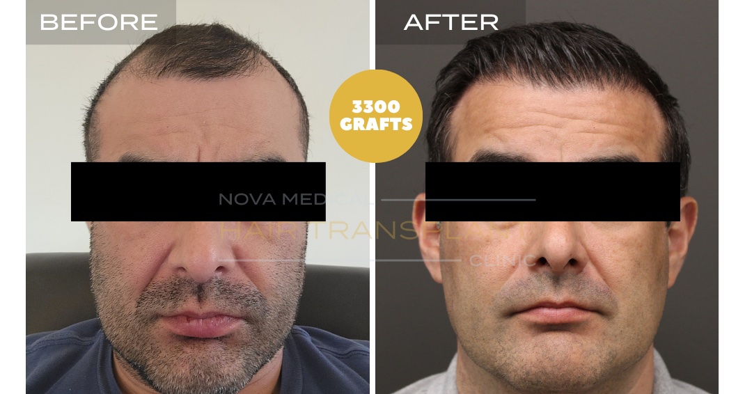 Hair Transplant Before & After Result 16 - HAIRLINE + FRONTAL DENSITY RESTORATION. MANUAL FUE + DHI 3300 GRAFTS., Nova Medical Kentucky