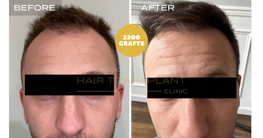 Hair Transplant Before & After Result 17 - HAIRLINE + CROWN DENSITY FILLING. MANUAL FUE 2200 GRAFTS., Nova Medical Kentucky