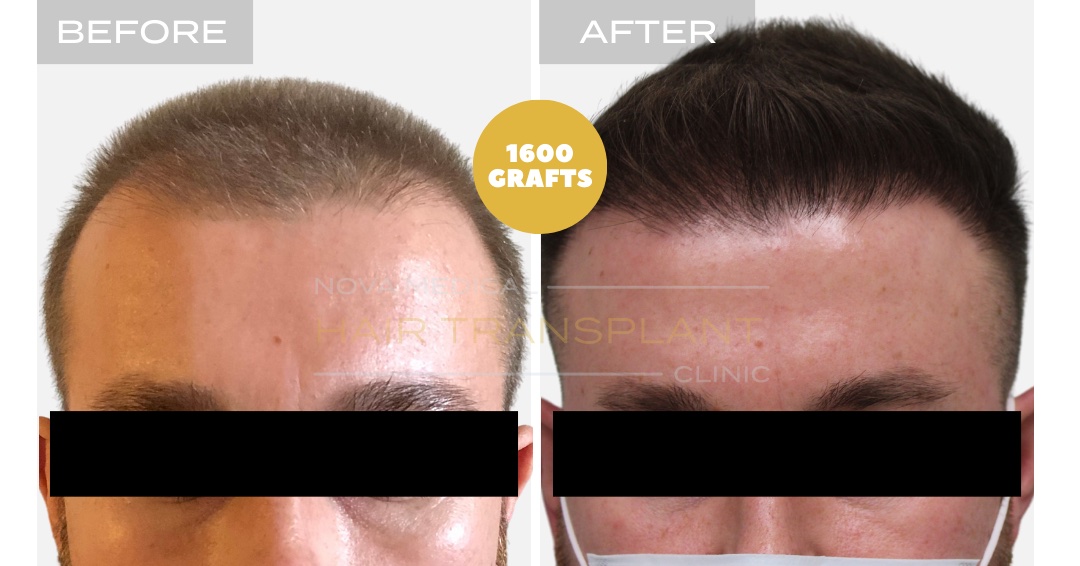 Hair Transplant Before & After Result 18 - HAIRLINE RESTORATION TOUCHUP. MANUAL FUE 1600 GRAFTS., Nova Medical Kentucky