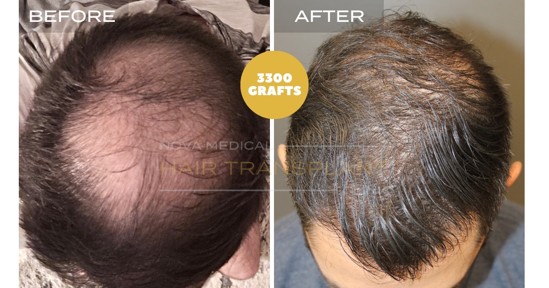 Hair Transplant Before & After Result 19 - CROWN + HAIRLINE RESTORATION. MANUAL FUE 3300 GRAFTS., Nova Medical Kentucky