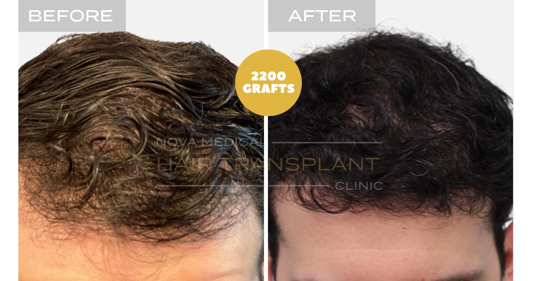 Hair Transplant Before & After Result 21 - HAIRLINE + DENSITY RESTORATION. MANUAL FUE 2200 GRAFTS., Nova Medical Kentucky