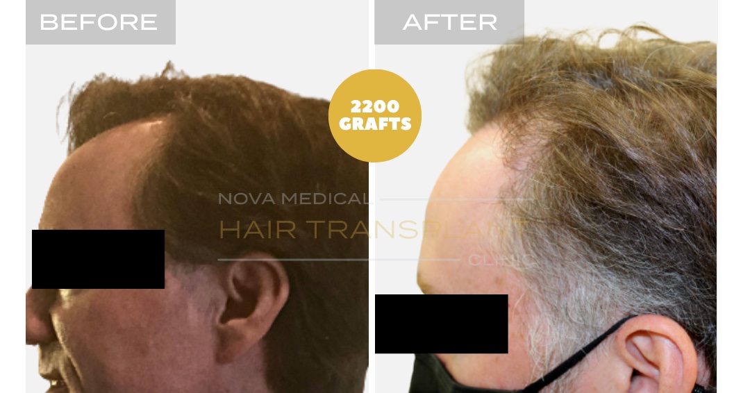 Hair Transplant Before & After Result 22 - TEMPLE FILLING + HAIRLINE RESTORATION. MANUAL FUE 2200 GRAFTS., Nova Medical Kentucky