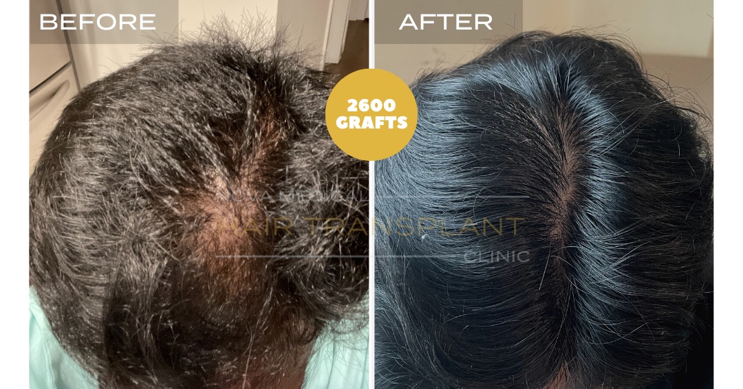 Hair Transplant Before & After Result 23 - CROWN DENSITY RESTORATION. MANUAL FUE 2600 GRAFTS., Nova Medical Kentucky