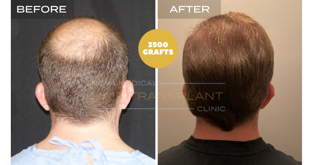 Hair Transplant Before & After Result 24 - CROWN DENSITY RESTORATION. MANUAL FUE 3500 GRAFTS., Nova Medical Kentucky