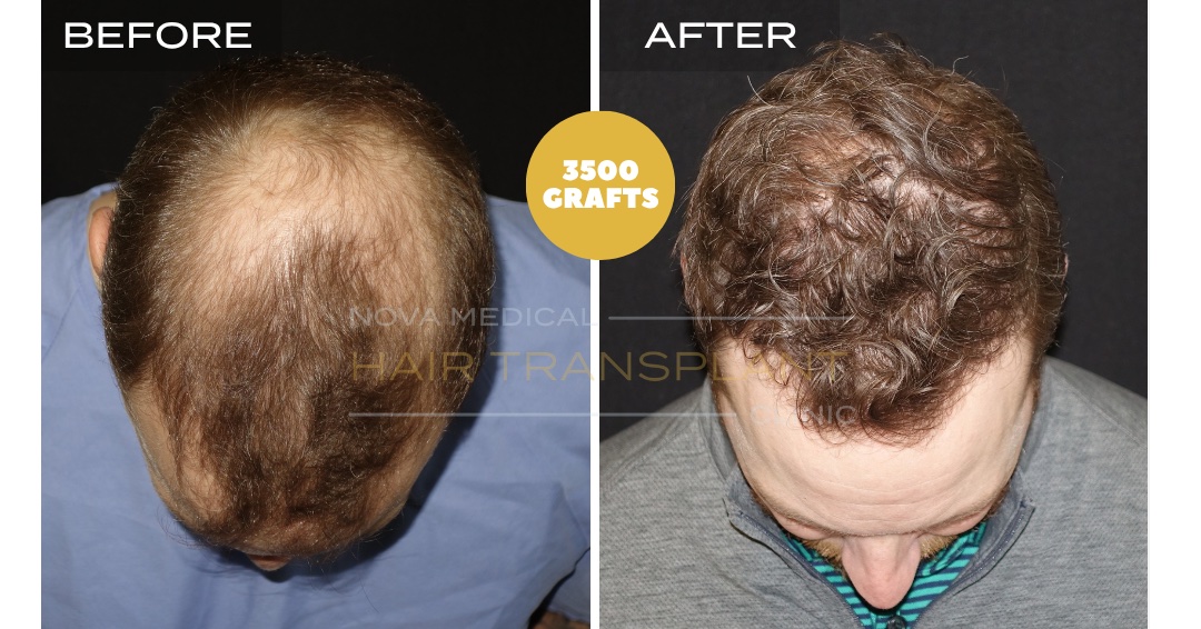 Hair Transplant Before & After Result 25 - CROWN + HAIRLINE RESTORATION. MANUAL FUE 3500 GRAFTS., Nova Medical Kentucky