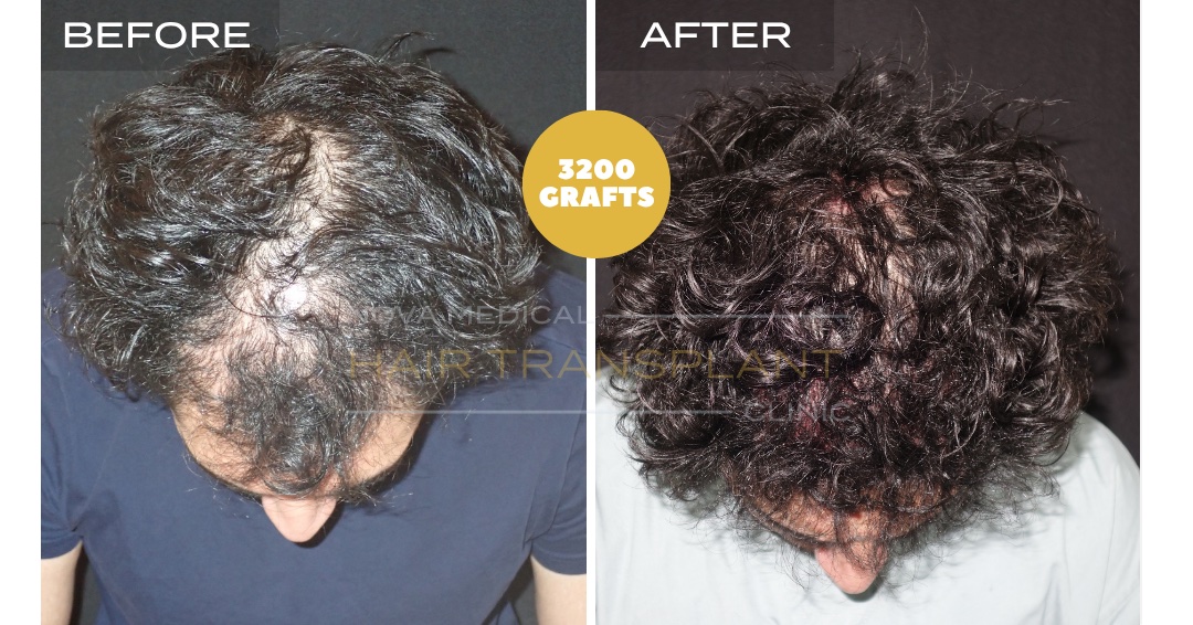 Hair Transplant Before & After Result 26 - DENSITY RESTORATION. MICRO FUE 3200 GRAFTS., Nova Medical Kentucky