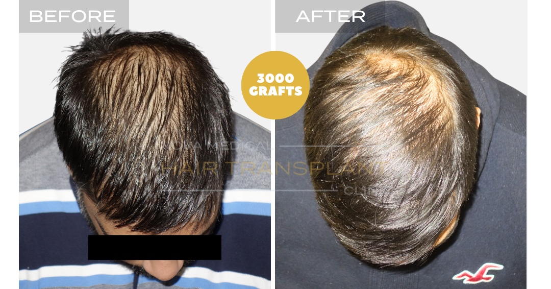 Hair Transplant Before & After Result 27 - HAIRLINE + DENSITY RESTORATION. MANUAL FUE 3000 GRAFTS., Nova Medical Kentucky