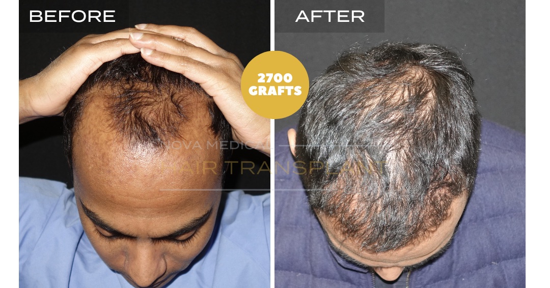 Hair Transplant Before & After Result 28 - HAIRLINE + DENSITY RESTORATION. MANUAL FUE 2700 GRAFTS., Nova Medical Kentucky