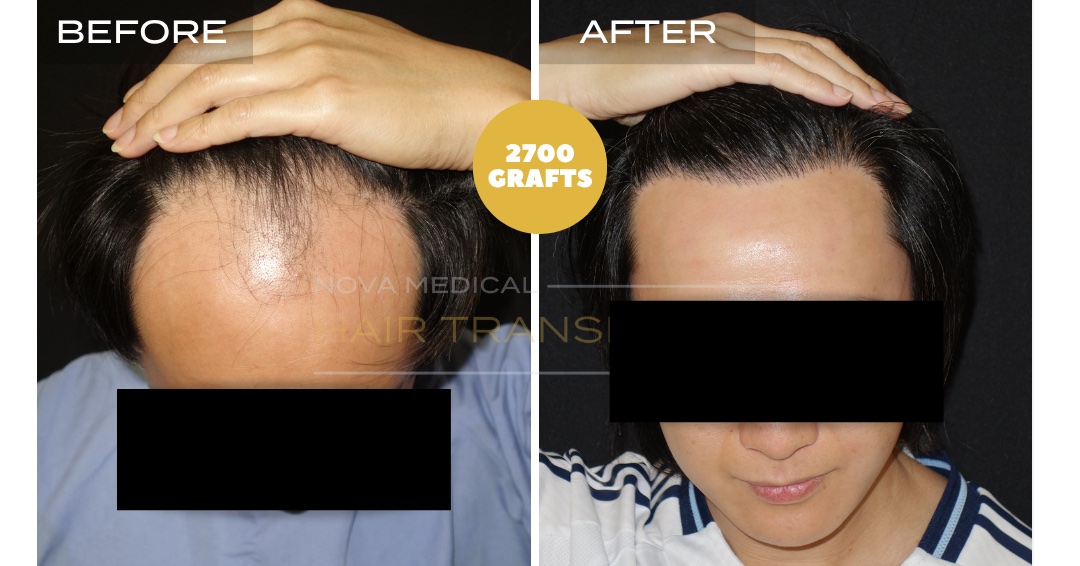 Hair Transplant Before & After Result 29 - HAIRLINE RESTORATION. MANUAL FUE 2700 GRAFTS., Nova Medical Kentucky