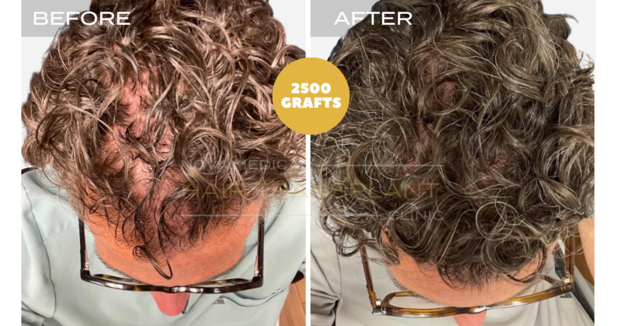 Hair Transplant Video Case Study 1 - SHAVELESS MANUAL FUE 2500 GRAFTS FOR CURLY HAIR. DENSITY FILLING., Nova Medical Kentucky