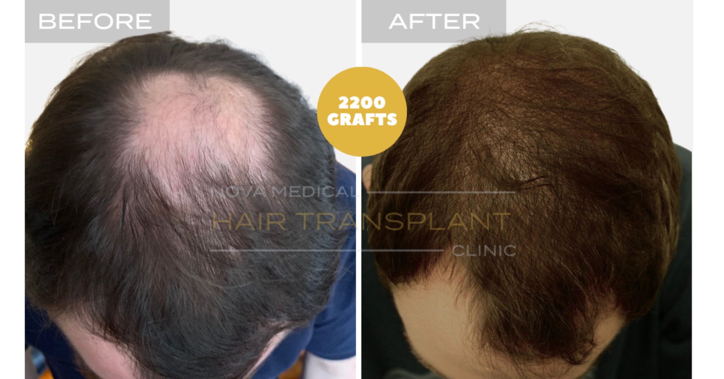 Hair Transplant Video Case Study 2 - CROWN FILLING. MANUAL FUE 2200 GRAFTS + DHI., Nova Medical Kentucky