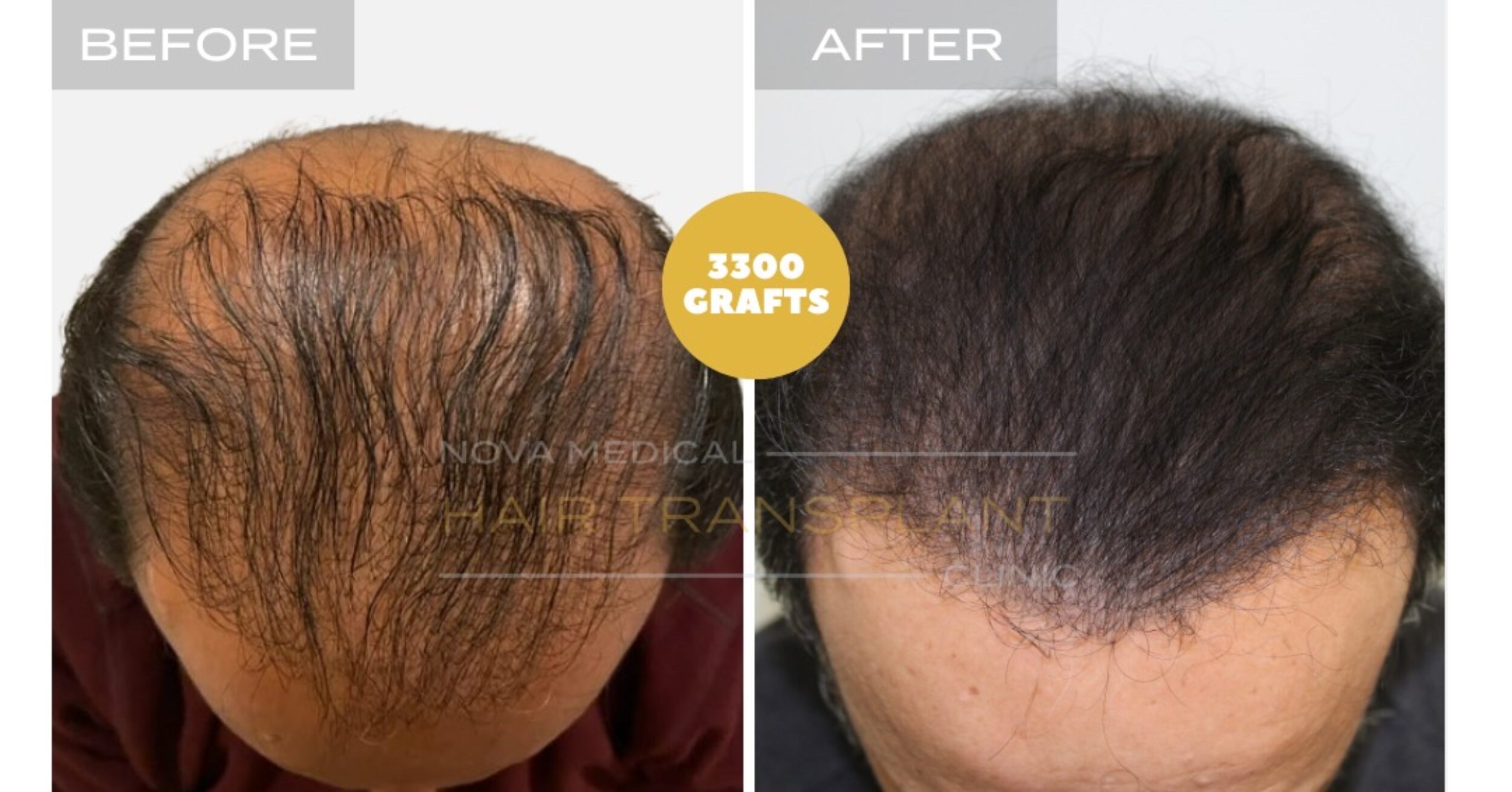 Hair Transplant Video Case Study 3 - LIMITED DONOR AREA. FIXING FACE TO FACE APPEARANCE + DENSITY FILLING, Nova Medical Kentucky