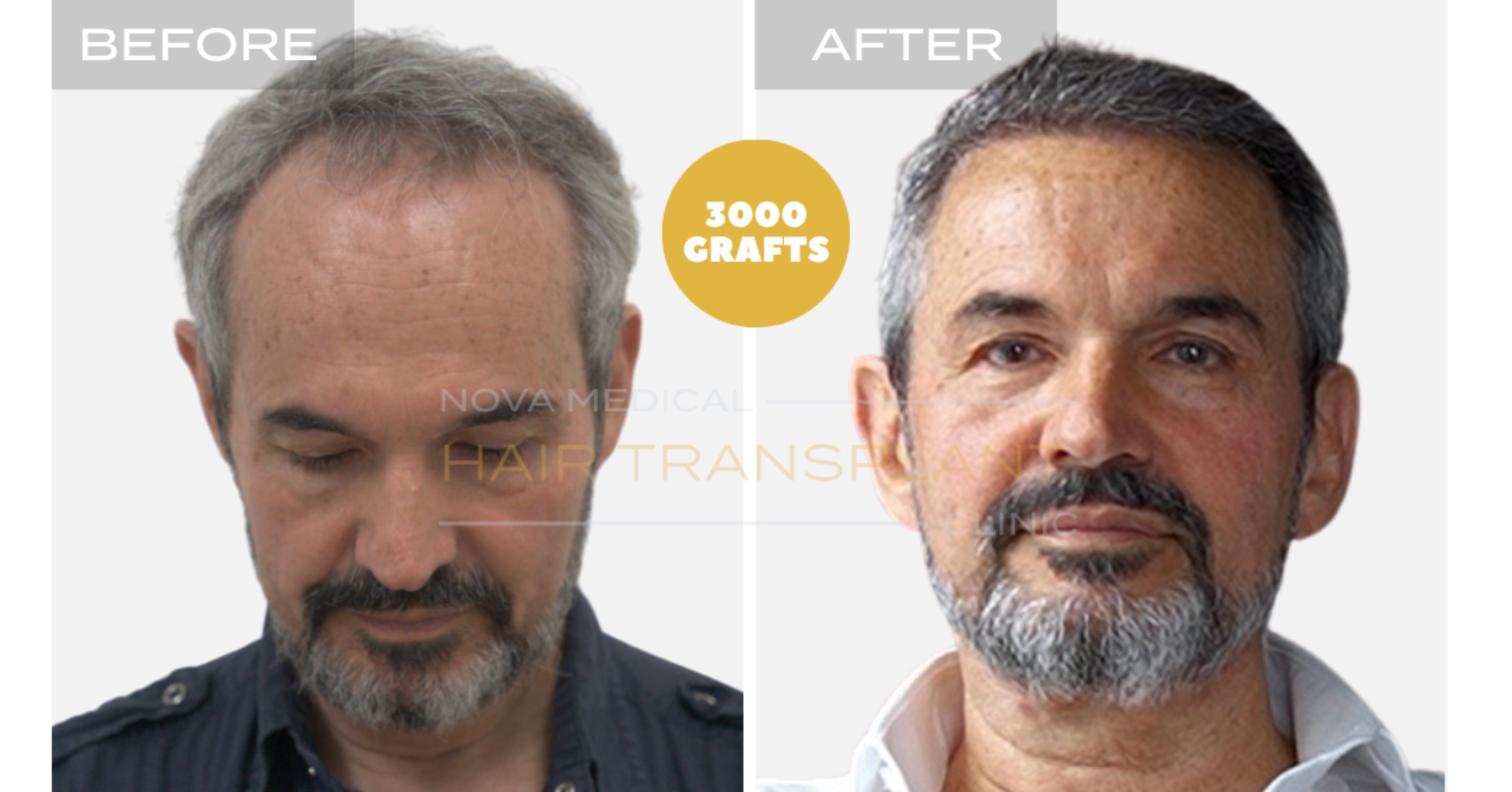 Hair Transplant Video Case Study 4 - HAIRLINE RESTORATION + DENSITY FILLING. MANUAL FUE 3000 GRAFTS., Nova Medical Kentucky