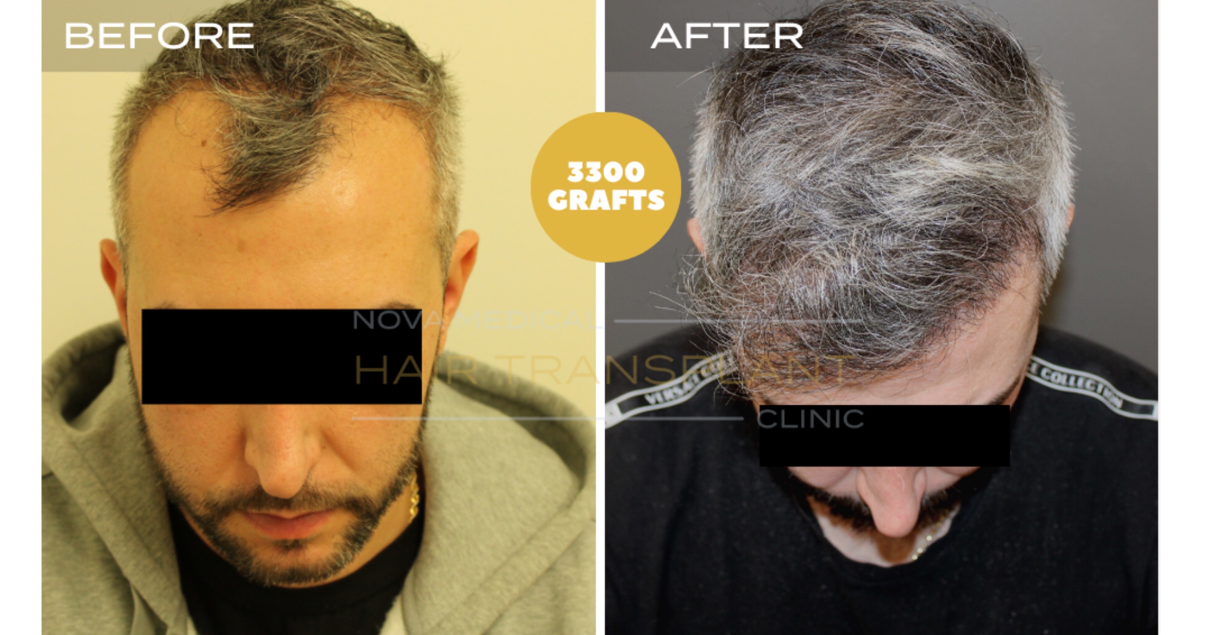 Hair Transplant Video Case Study 5 - HAIRLINE RESTORATION DENSITY FILLING. MANUAL FUE 3300 GRAFTS., Nova Medical Kentucky
