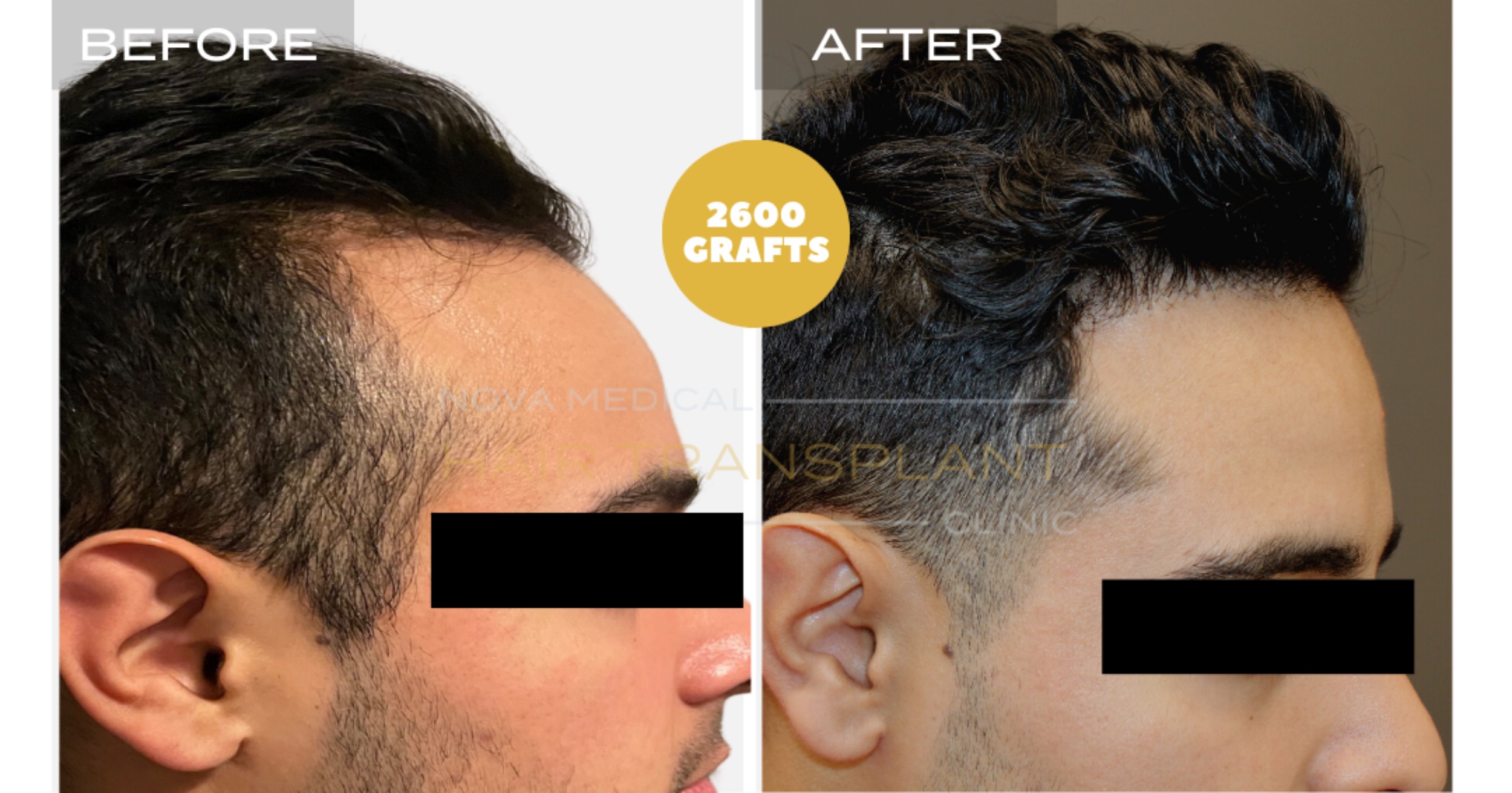 Hair Transplant Video Case Study 6 - TEMPLE FILLING + HAIRLINE RESTORATION. MANUAL FUE 2600 GRAFTS., Nova Medical Kentucky