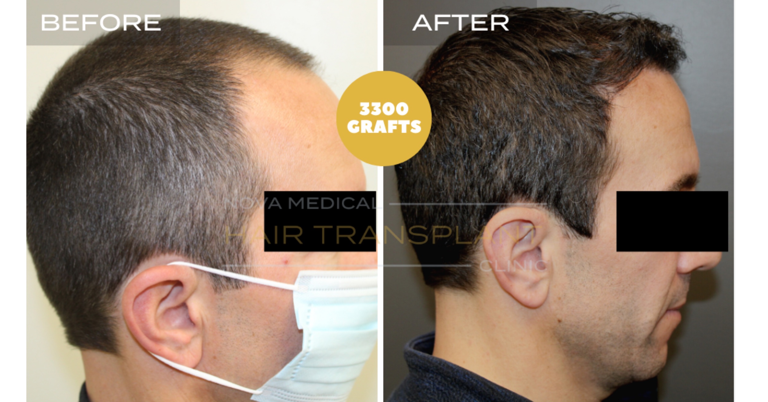 Hair Transplant Video Case Study 7 - TEMPLE FILLING + HAIRLINE RESTORATION. MANUAL FUE 3300 GRAFTS., Nova Medical Kentucky