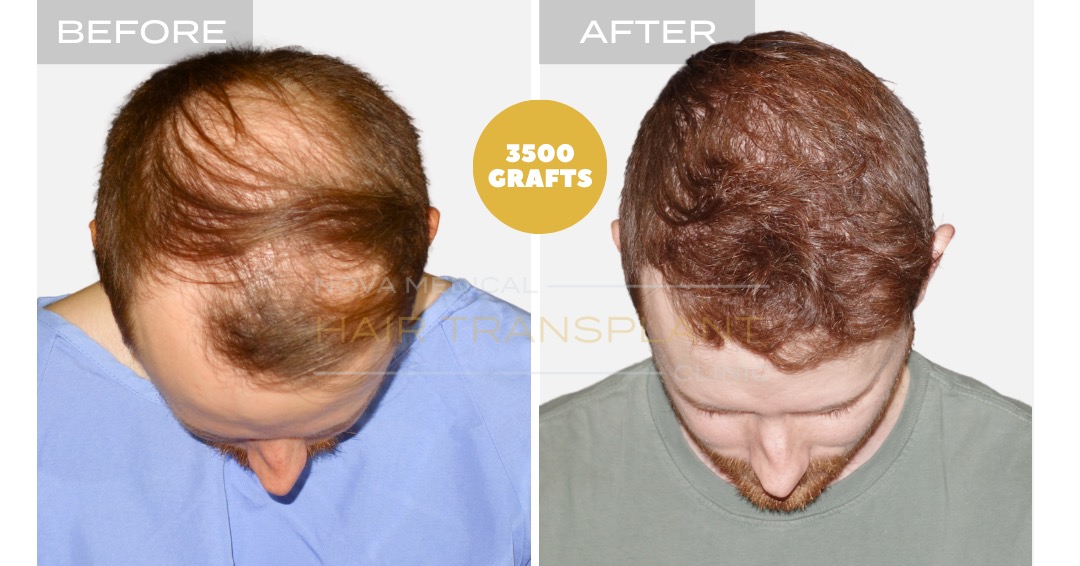Hair Transplant Before and After - Patient 2, Nova Medical Kentucky
