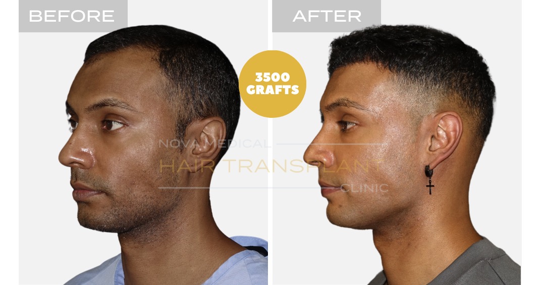 Hair Transplant Before and After - Patient 3, Nova Medical Kentucky