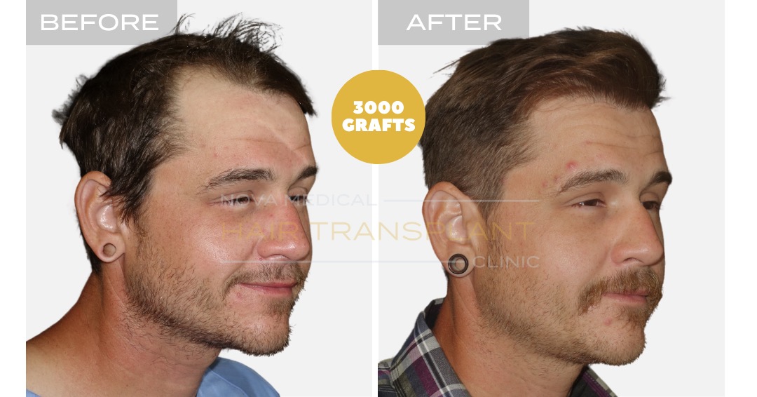 Hair Transplant Before and After - Patient 4, Nova Medical Kentucky