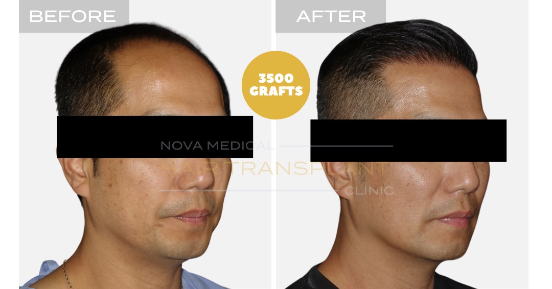 Hair Transplant Before and After - Patient 5, Nova Medical Kentucky