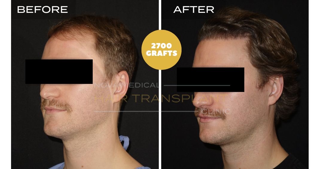 Hair Transplant Before and After - Patient 5 angle 2, Nova Medical Kentucky