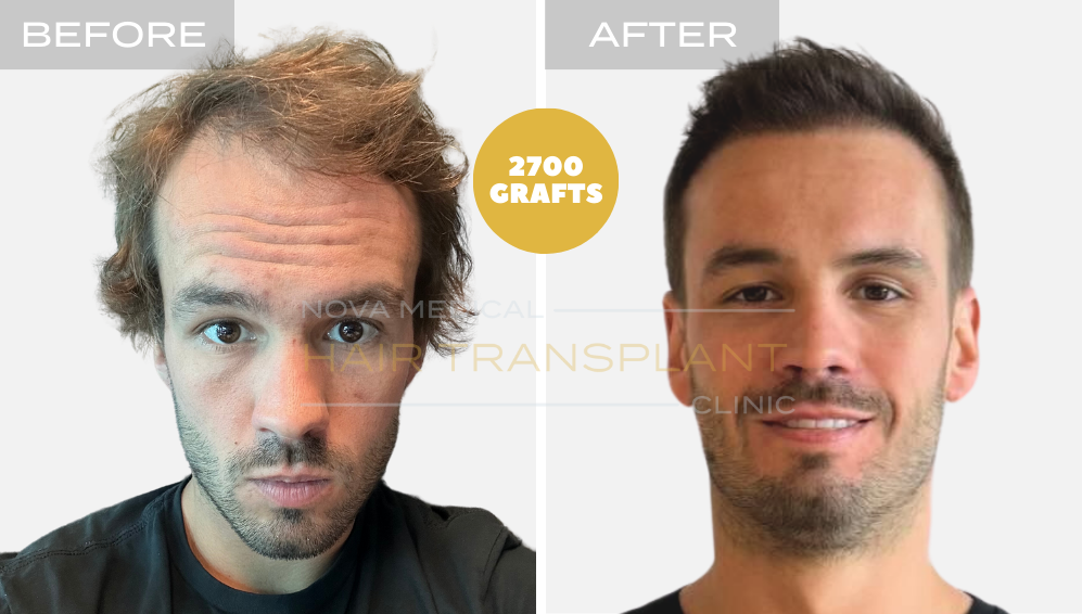 Hair transplant result