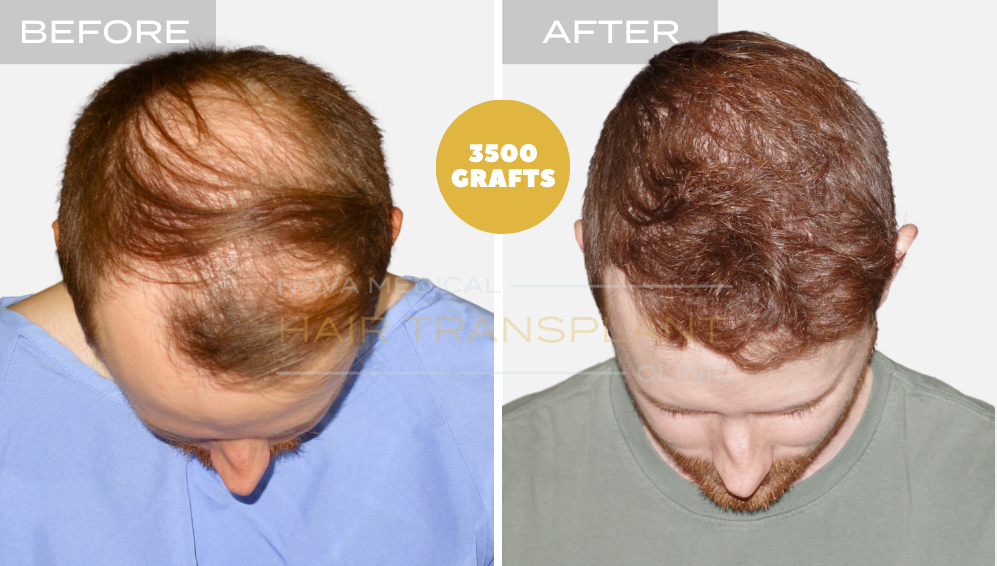 Hair transplant result