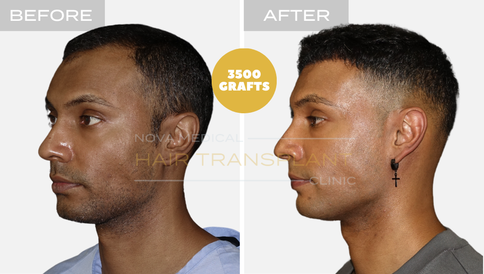 Hair transplant result